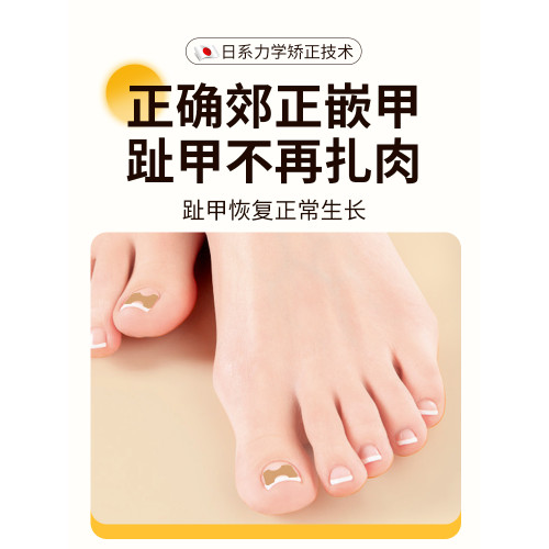 甲溝矯正器日本正甲貼嵌甲腳指甲糾正器專用貼腳趾正甲片甲溝墊炎