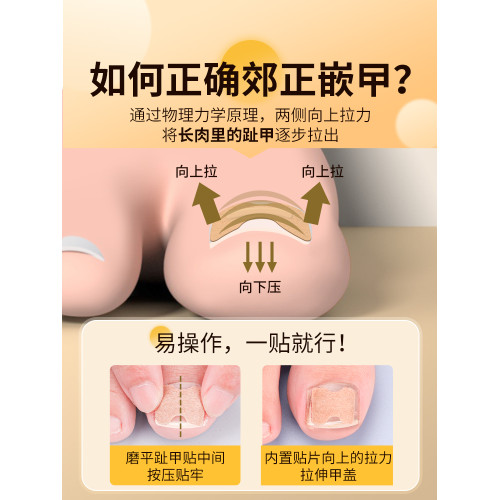 甲溝矯正器日本正甲貼嵌甲腳指甲糾正器專用貼腳趾正甲片甲溝墊炎