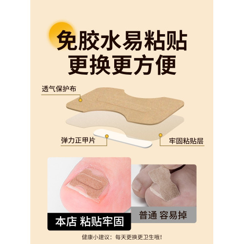 甲溝矯正器日本正甲貼嵌甲腳指甲糾正器專用貼腳趾正甲片甲溝墊炎