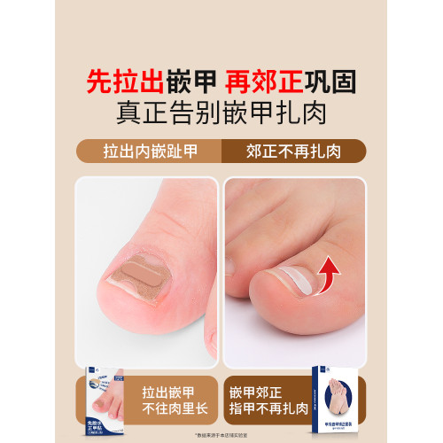 甲溝矯正器日本正甲貼嵌甲腳指甲糾正器專用貼腳趾正甲片甲溝墊炎