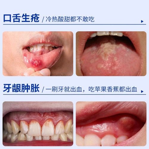 漱口水去異味持久畱香殺菌除口臭清新口氣毉用口腔清潔液一次性裝